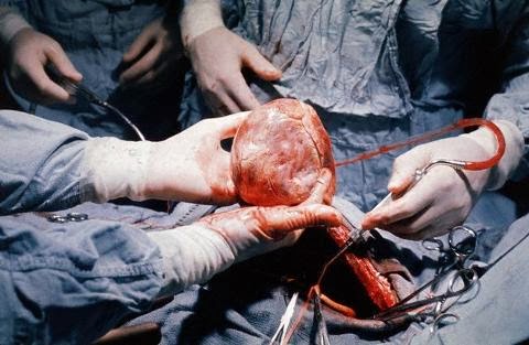 heart-transplantation